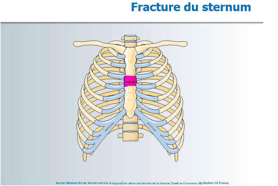 douleur sous le sternum