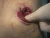 colostomie-1.jpg
