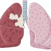 Poumons cancer