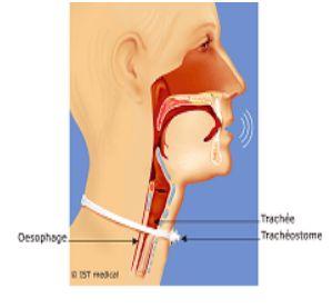 tracheostomie-1.jpg
