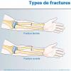 Types de fractures 2